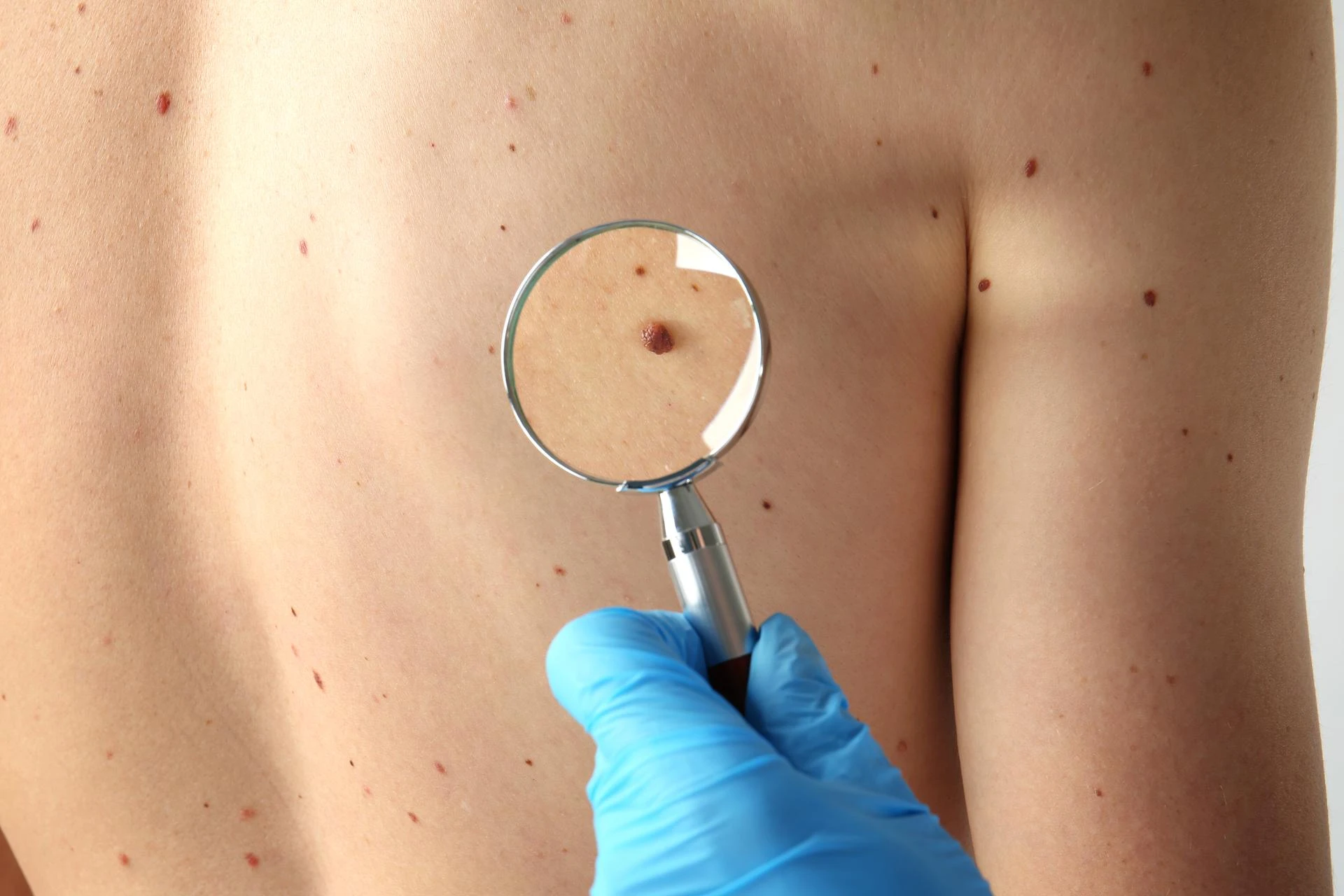 Skin Tag Removal